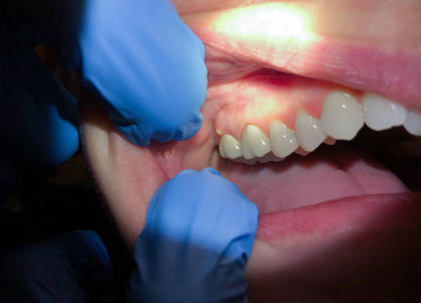 Best Emergency Root Canal Treatment in Ravenna, MI
