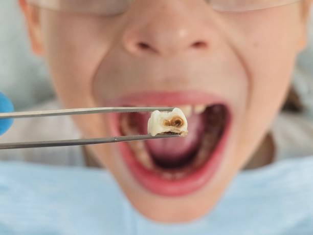 Best Emergency Dental Extractions in Ravenna, MI